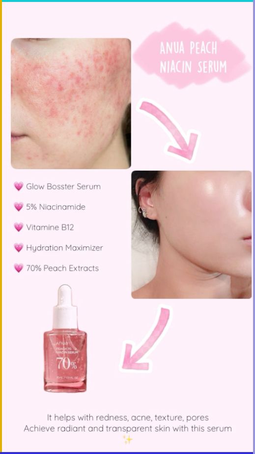 Anua, Niacinamide 10% + TXA 4% Dark Spot Correcting Serum